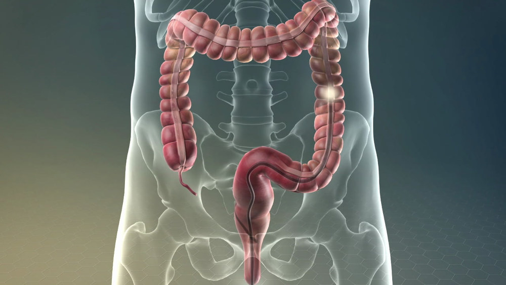 віртуальна колоноскопія