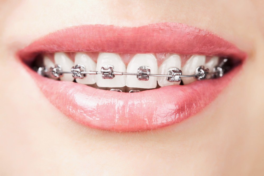 brillant dental brillant.dental