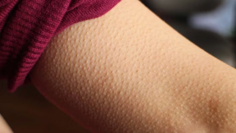 Чому від переляку з’являються мурашки на шкірі: фізіологія пілоерекції